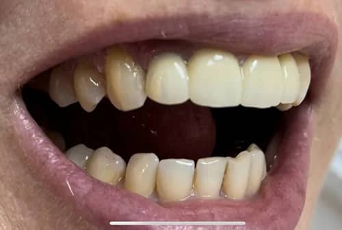 зубные импланты