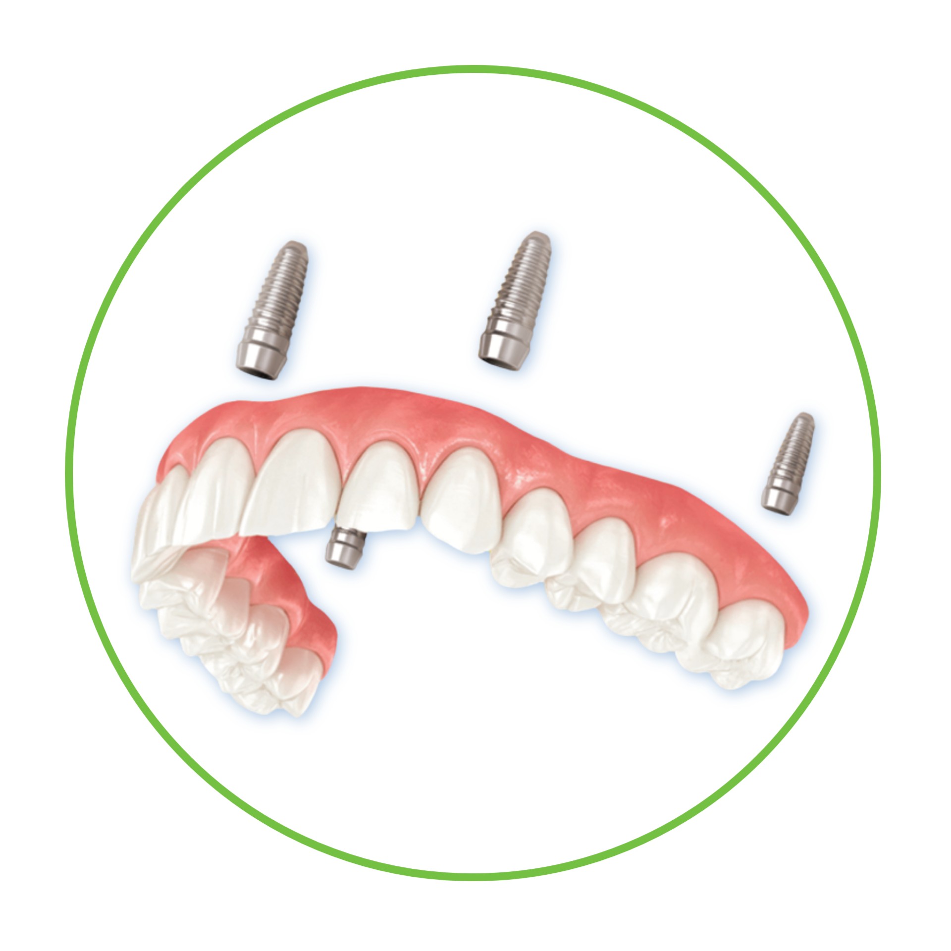 протезирование на 4х имплантах